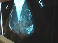 New Law May Help Women With Dense Breasts