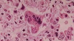Woman's Measles Death the 1st in U.S. Since 2003