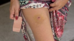 Woman Shot in Leg But Doesn't Realize Until Days Later