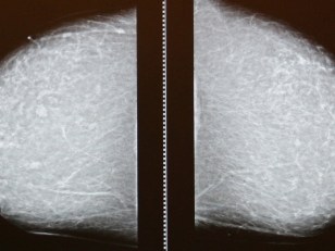 Ask the Doc Your Mammogram Questions