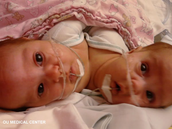 Conjoined Twins Separated