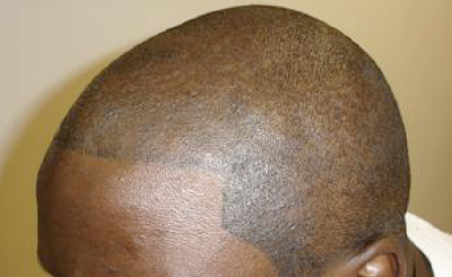 Going Bald? Get Your Head Tattooed