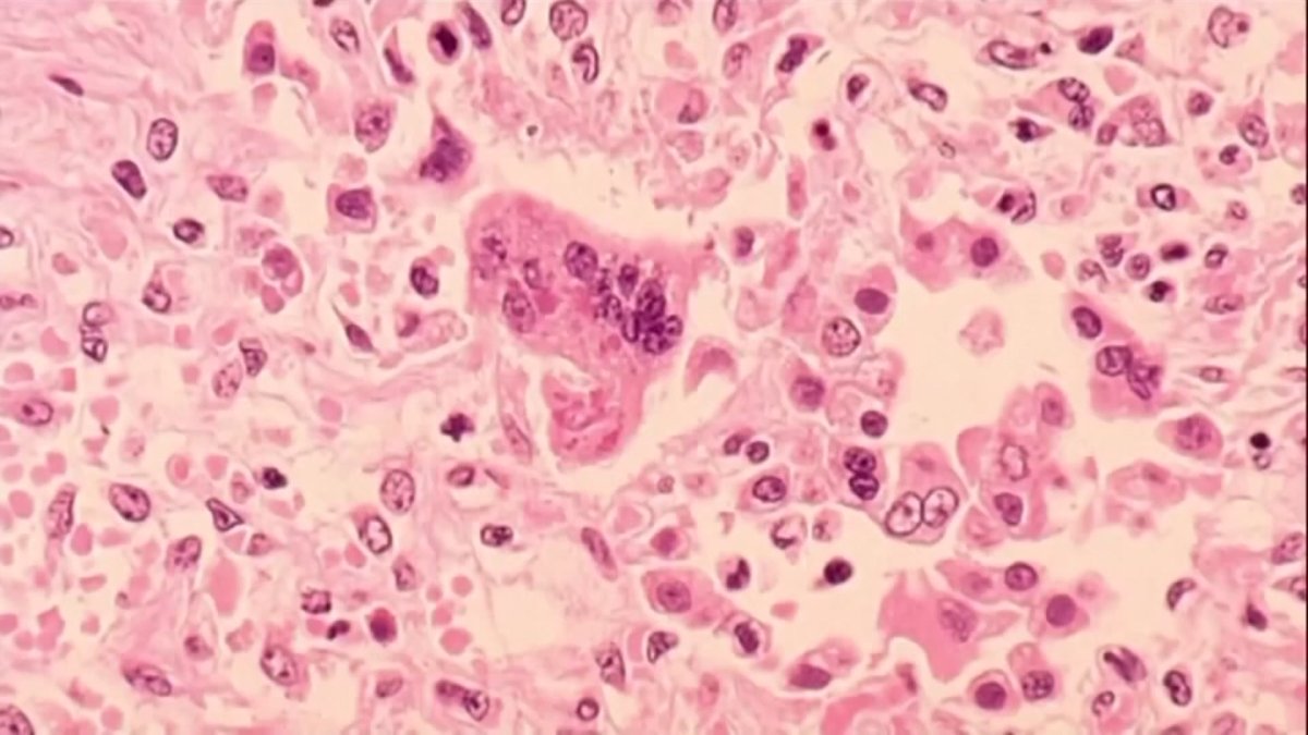 Measles Case in Vaxxed Adult in CT – Doctors Reveal Shocking Truth