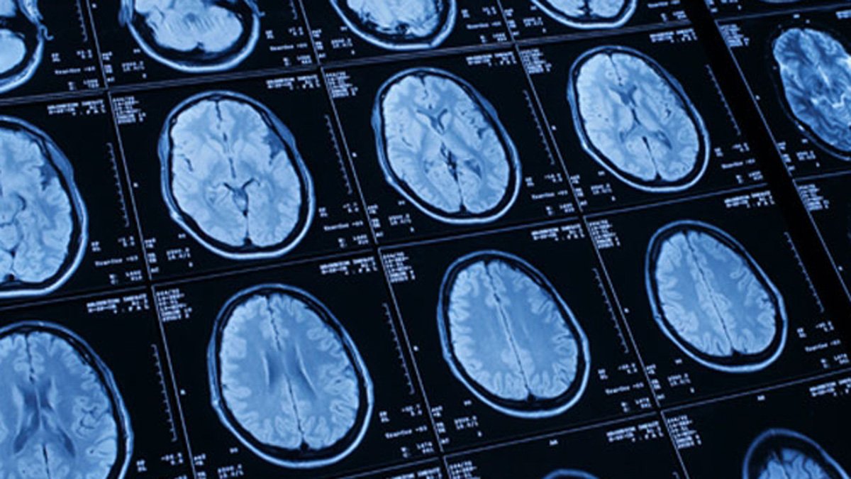 Doctor Admits to Receiving Kickbacks for Sham Brain Scans - Vimarsana News