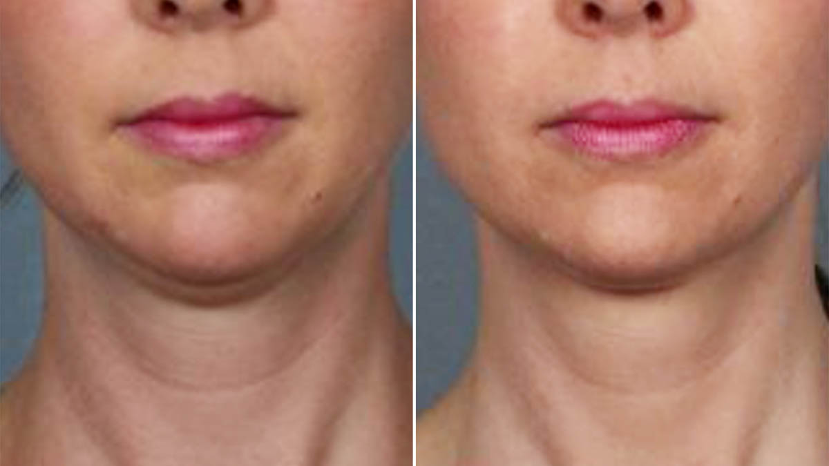 Could New “FatMelting” Injection End Double Chins? NBC Connecticut