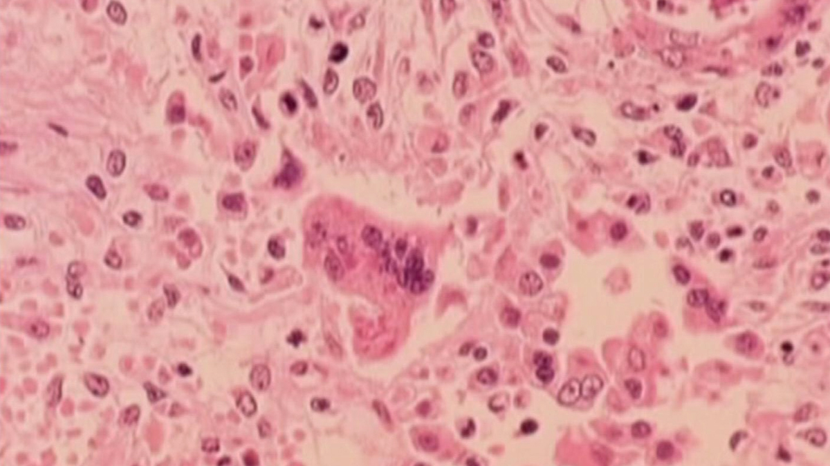 Child infected with measles attends school in Trumbull: town officials