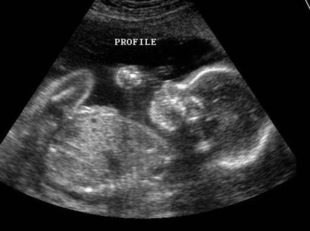 ultrasound_640x480