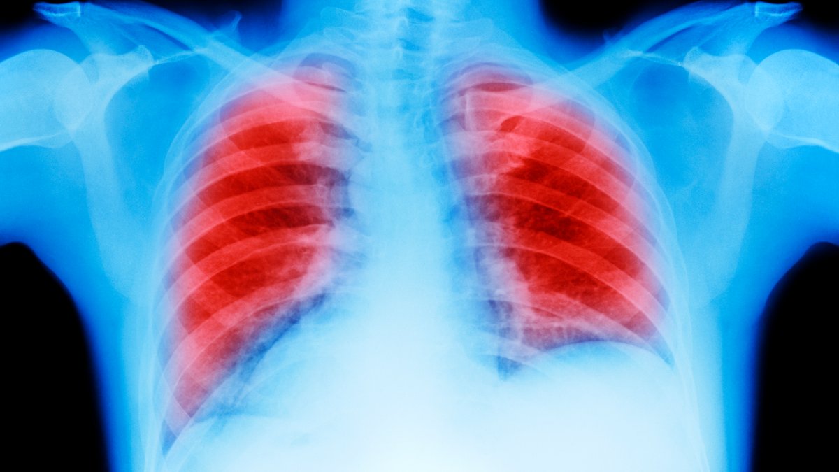 Double Lung Transplants Saves 2 Late-Stage Cancer Patients – NBC Connecticut - Vimarsana News