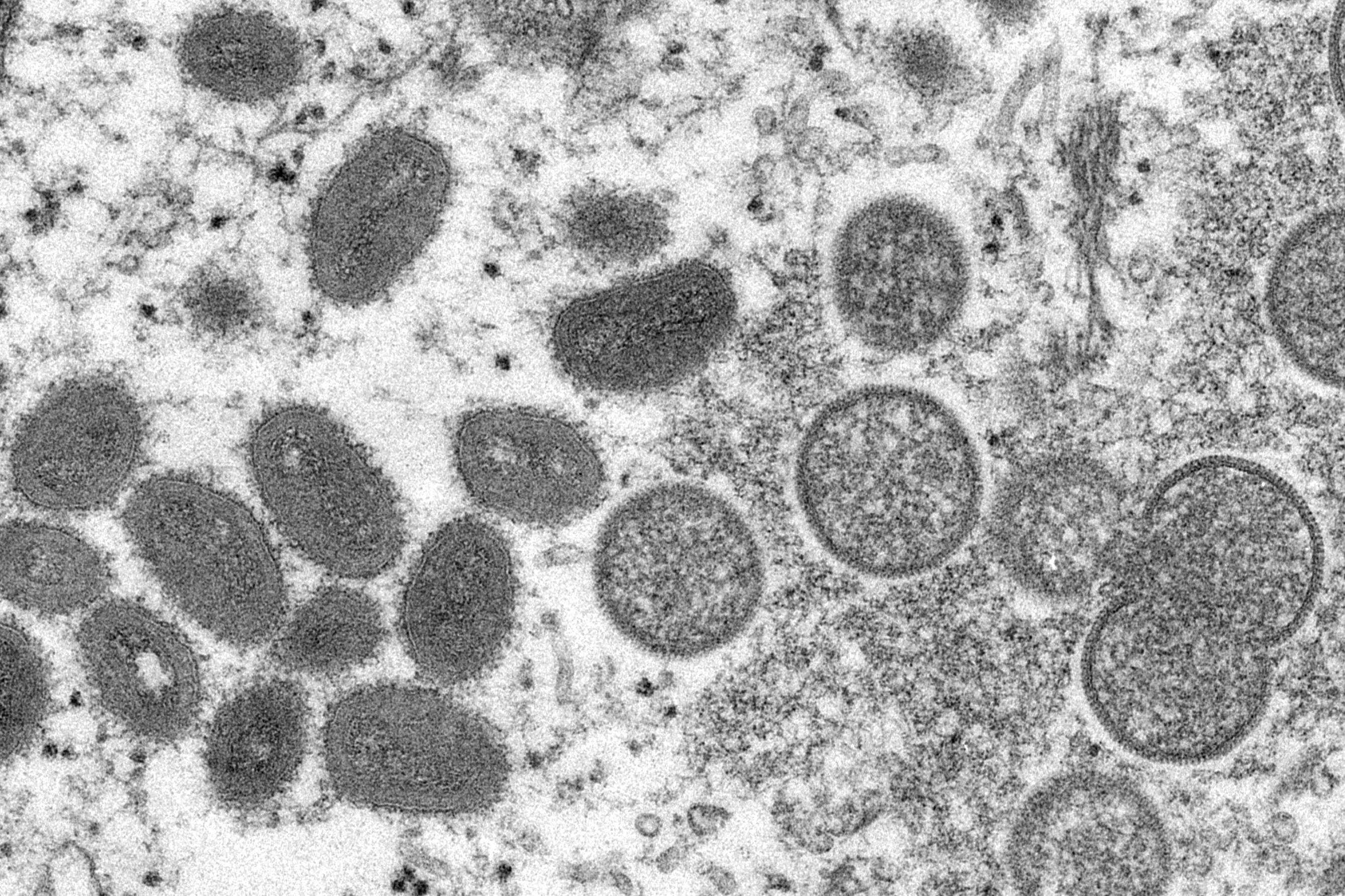 Israel Reports First Case of Monkeypox, Suspects Others – NBC Connecticut