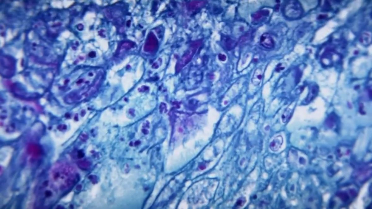 Monkeypox in Mass.: 2 More Cases Confirmed – NBC Connecticut - Vimarsana News