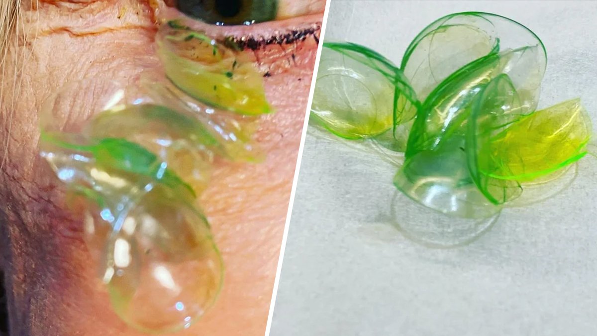 Woman Had 23 Contact Lenses Stuck Under Her Eyelid, Doctor Says – NBC Connecticut - Vimarsana News