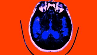Scan Of The Brain Of A Patient Affected By Alzheimer's Disease Axial Section. Median Portion Of Dilated Third Ventricle. Symmetrical And Rounded Dilation Of Intersections. Sylvian Fissure Is Quite Enlarged.