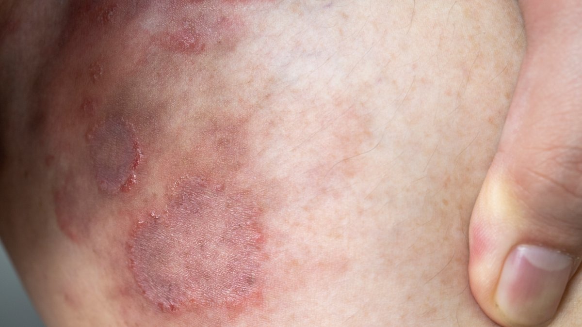 First Resistant Ringworm Infections Detected in United States – NBC Connecticut - Vimarsana News