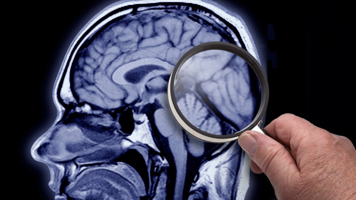 Health insurance companies may not cover new Alzheimer's drug Leqembi – NBC Connecticut - Vimarsana News