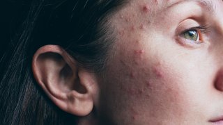 Woman with acne skin problem.