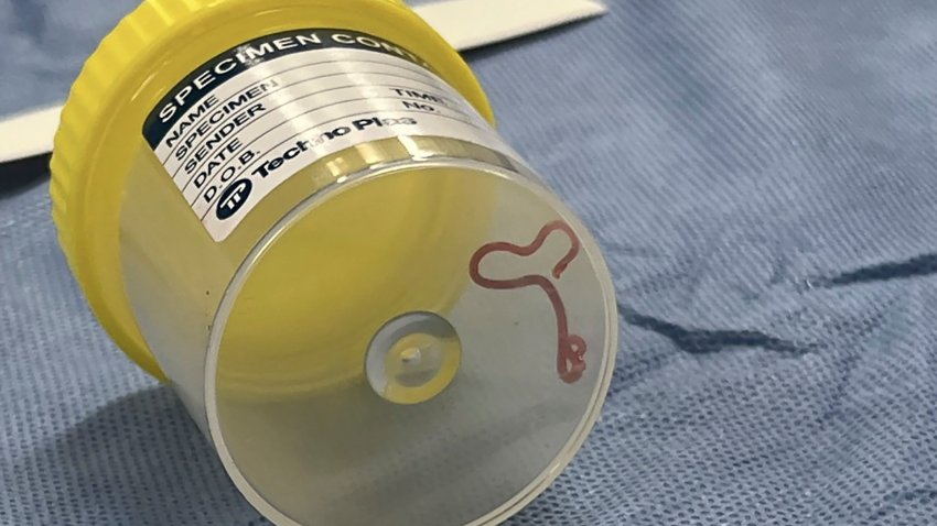 This undated photo supplied by Canberra Health Services, shows a parasite in a specimen jar at a Canberra hospital in Australia. A neurosurgeon investigating a patient’s mystery neurological symptoms in an Australian hospital has been surprised to pluck a 3-inch wriggling worm from her brain.