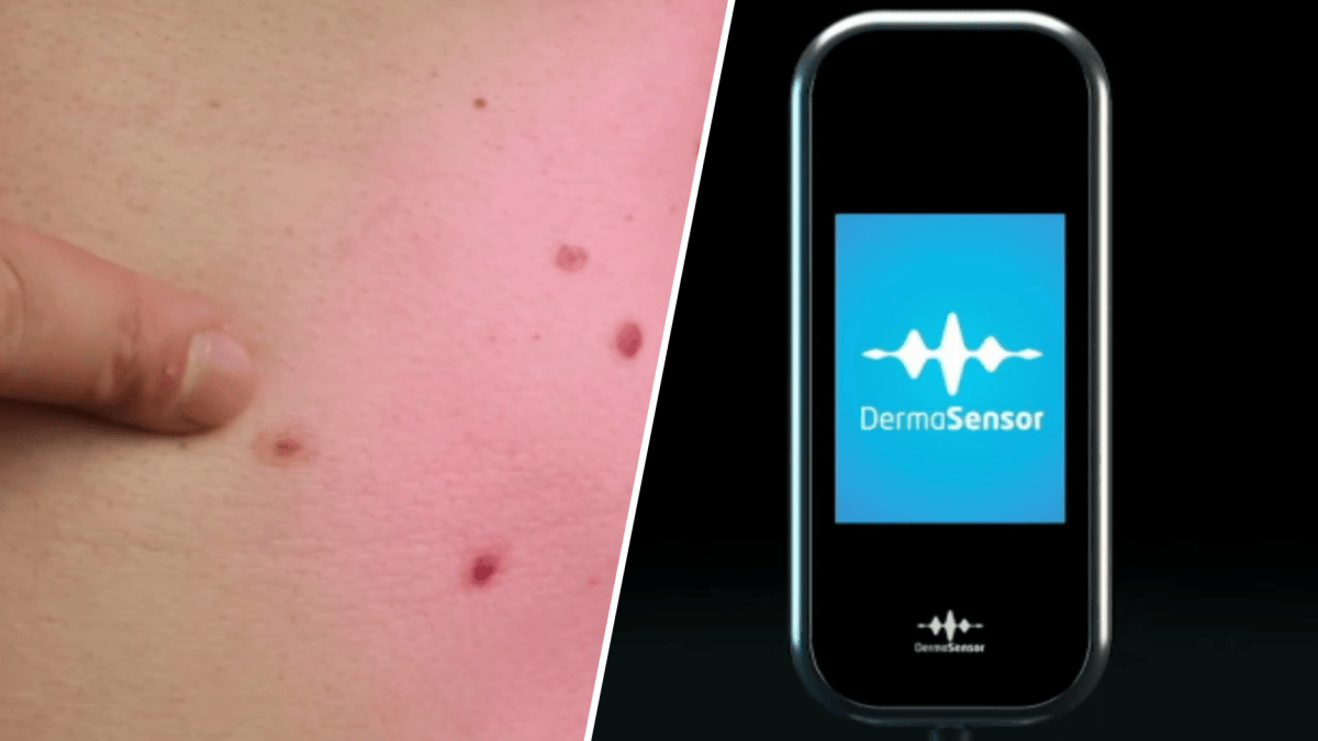 How an AI device the size of a phone detects skin cancer - Vimarsana News