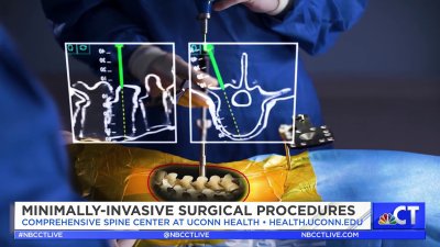 CT LIVE!: Minimally-Invasive Procedures at UConn Health's Comprehensive Spine Center