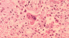 Person with measles visited Boston hotel, museum, airport, health officials warn
