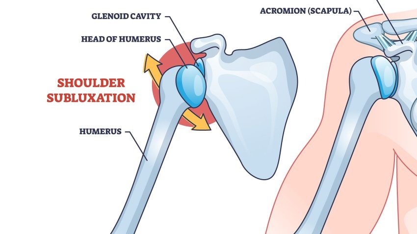 What is a shoulder subluxation?