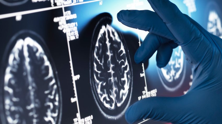 Doctor examining a human brain scan on screen