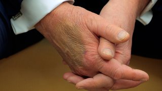 President Donald Trump's hands as he hosts French President Emmanuel Macron for meetings at the White House on Monday.