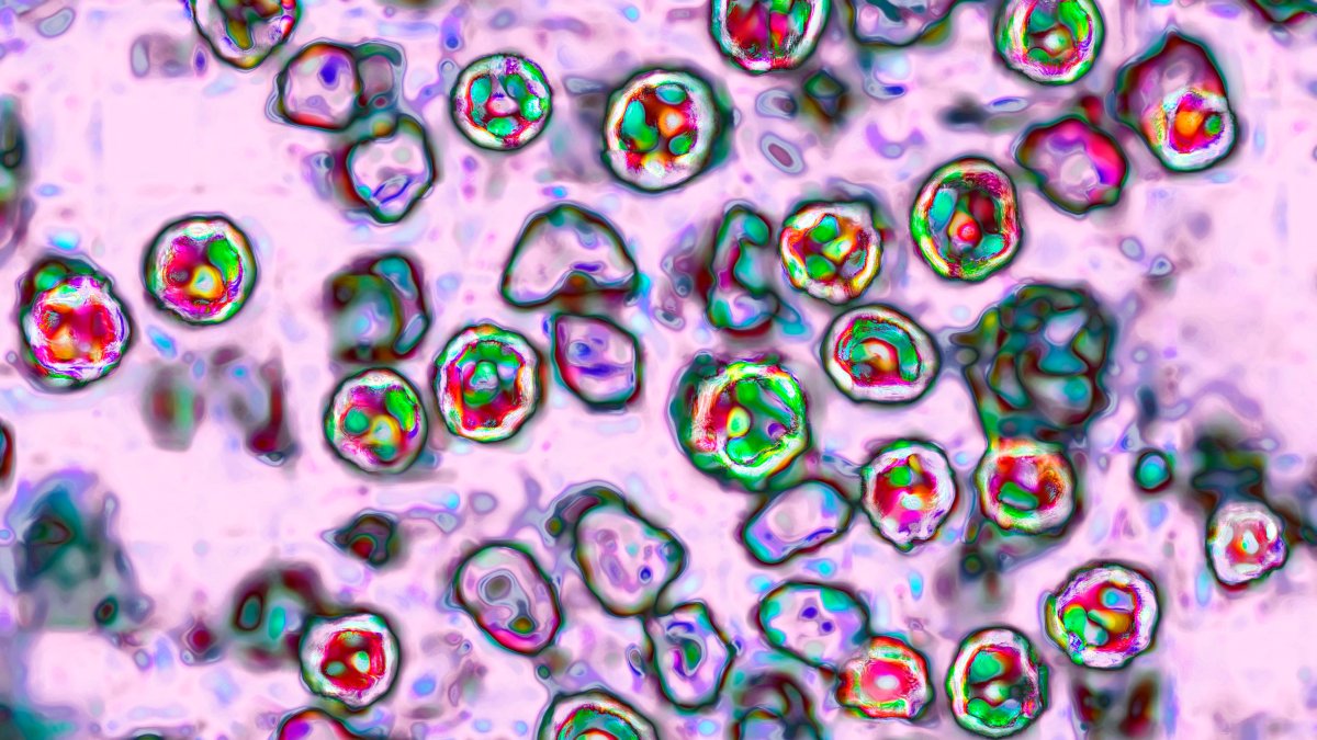 Recent measles case confirmed as third in Connecticut this year, DPH says