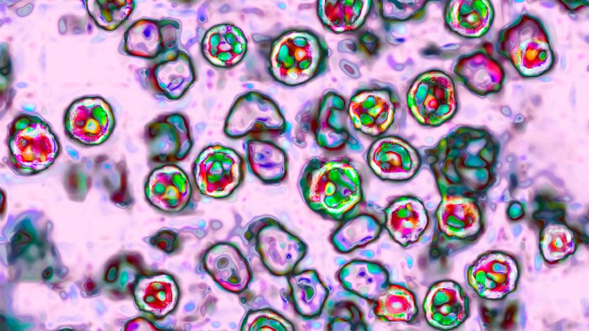 The measles virus, paramyxoviridae from the Morbillivirus family, transmission microscopy view. (Photo by: BSIP/Universal Images Group via Getty Images)