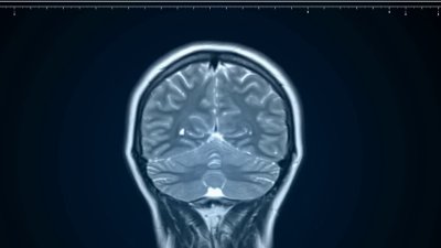 Raising awareness about brain cancer