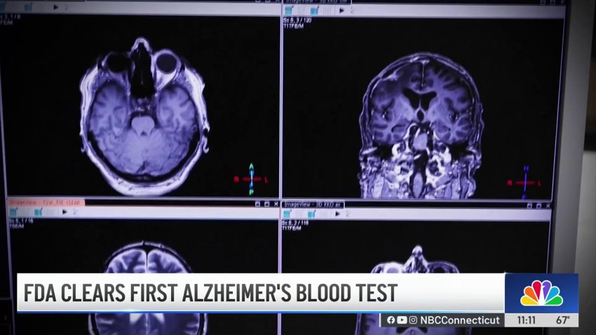 FDA clears first blood test for Alzheimer's disease