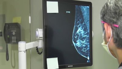 FDA approves AI platform to help determine risk for women to develop breast cancer