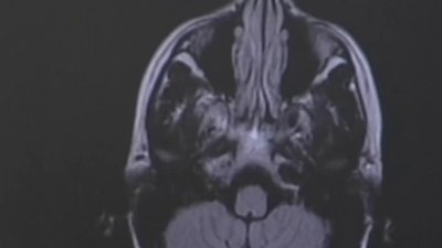 Hartford HealthCare launches study to revolutionize treatment of migraines