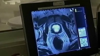 Raising awareness about early cancer detection