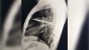 Doctors find knife embedded in Tanzania man's chest that was leaking pus