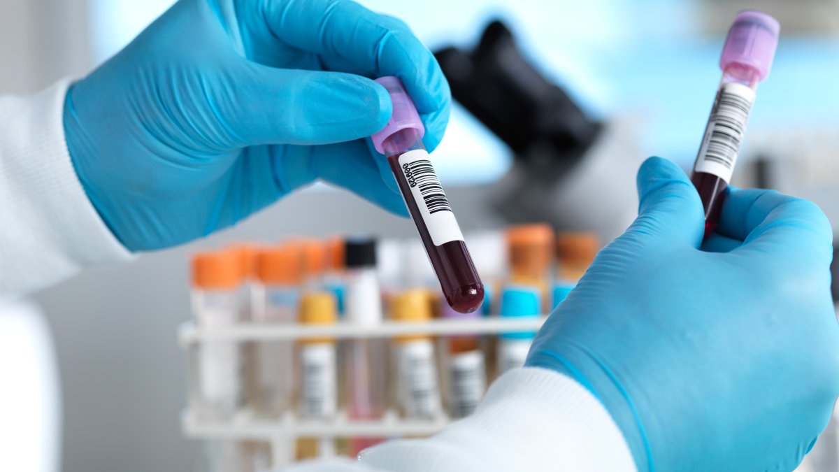 This blood test may predict heart disease better than ‘bad' cholesterol. Why aren't more getting it?