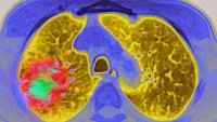 Lung cancer seen on an MRI scan.