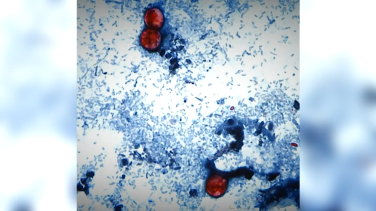 Cyclosporiasis outbreak sickens Connecticut residents as cases rise