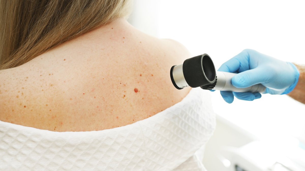 How a dermatologist monitors herself for skin cancer and the ‘big sign' a mole may be melanoma