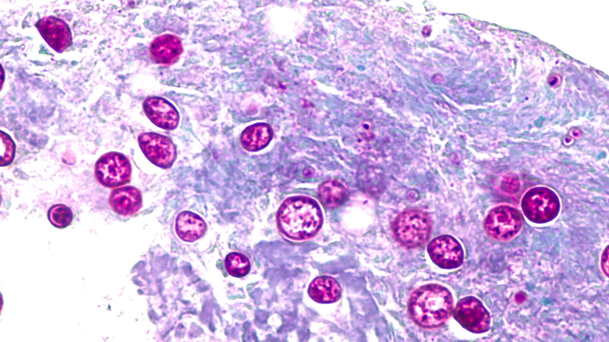 Connecticut reports 23 cases of cyclosporiasis as health officials urge produce washing