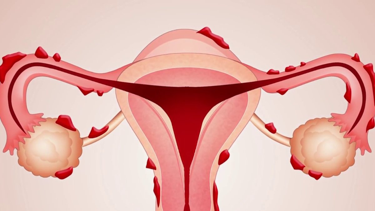 Beyond the Scale: Endometriosis patients report relief after using GLP-1s – NBC Connecticut