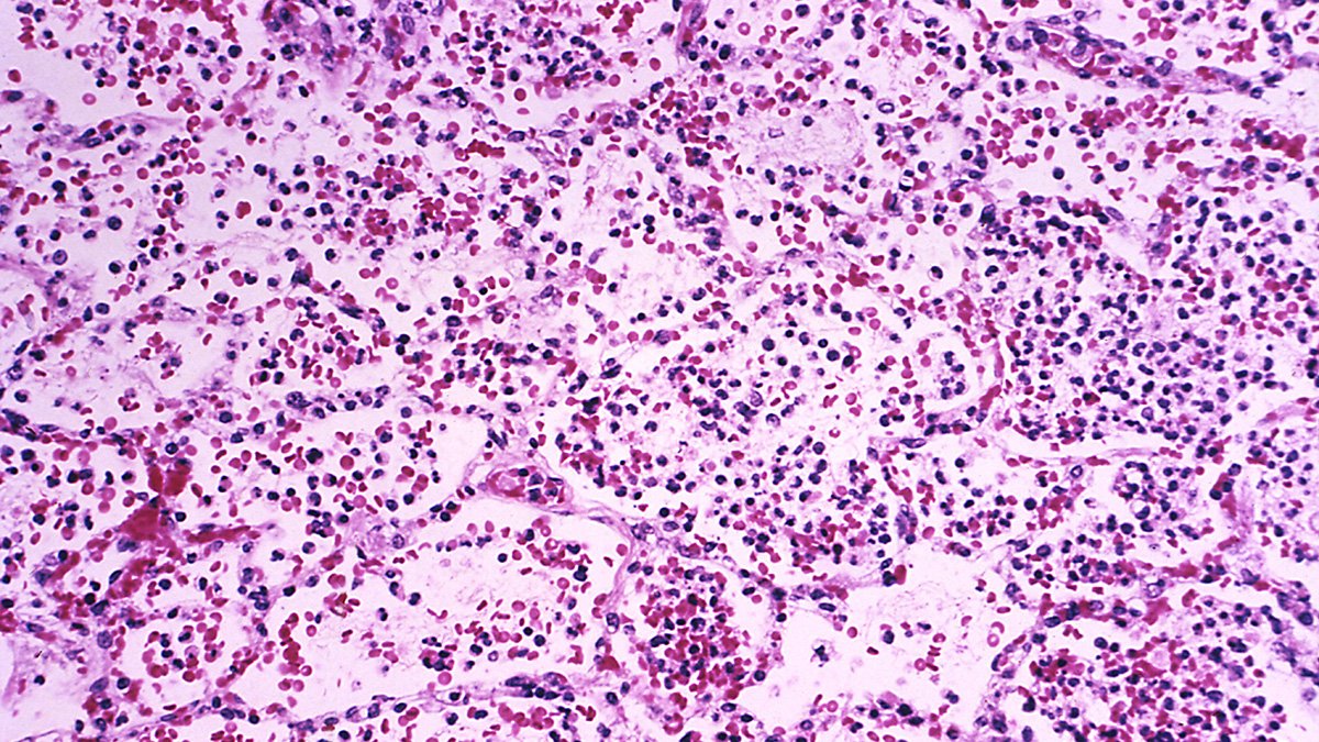 Worker at Russian Anti-Plague Lab Dies; U.S. Monitors Situation