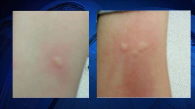 Gypsy moth rash